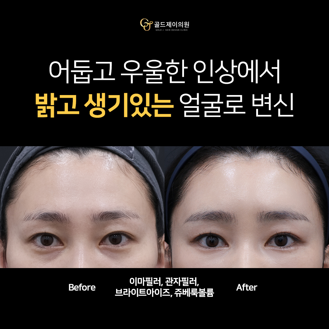 아치스퀘어 이마필러 전후 비교 1