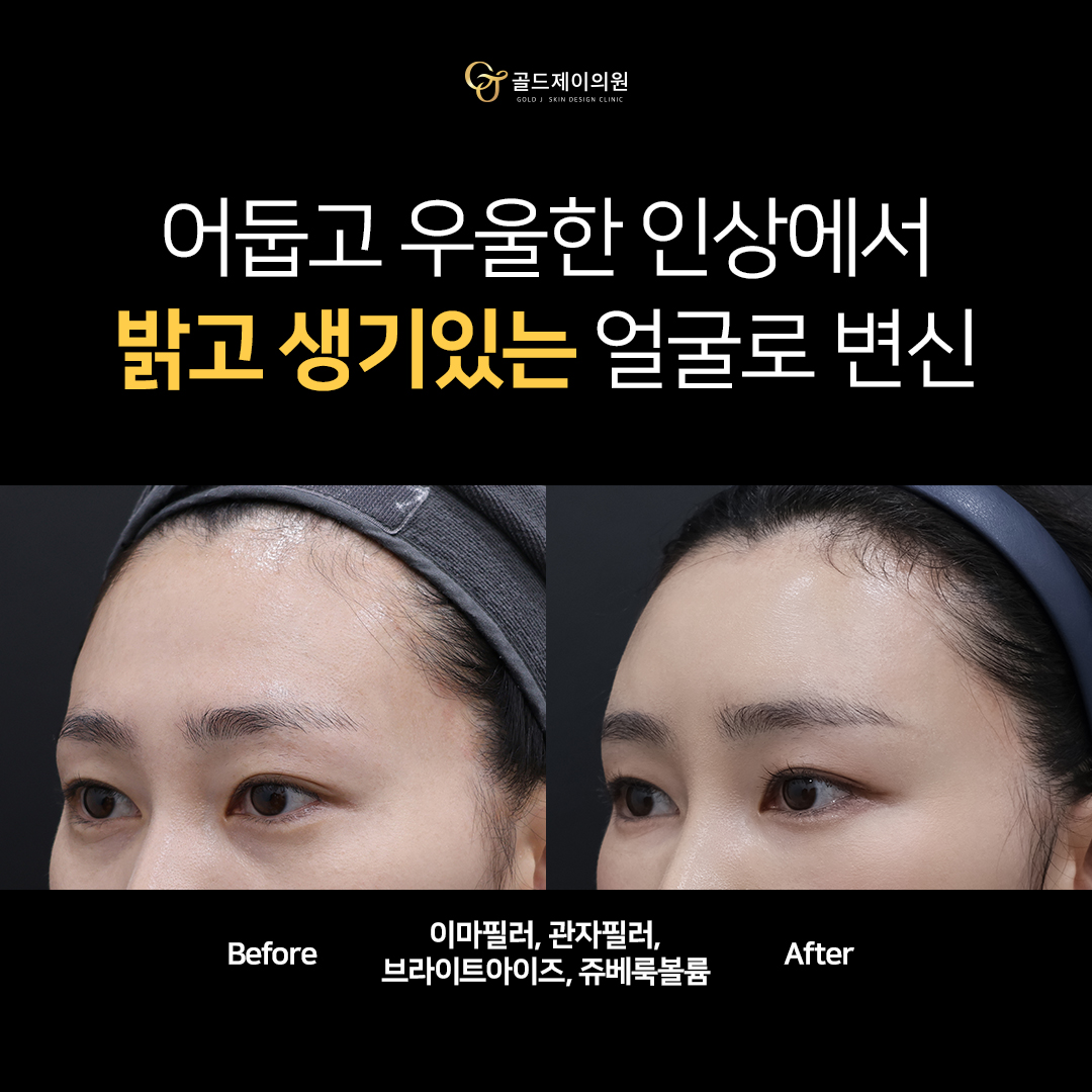 아치스퀘어 이마필러 전후 비교 2