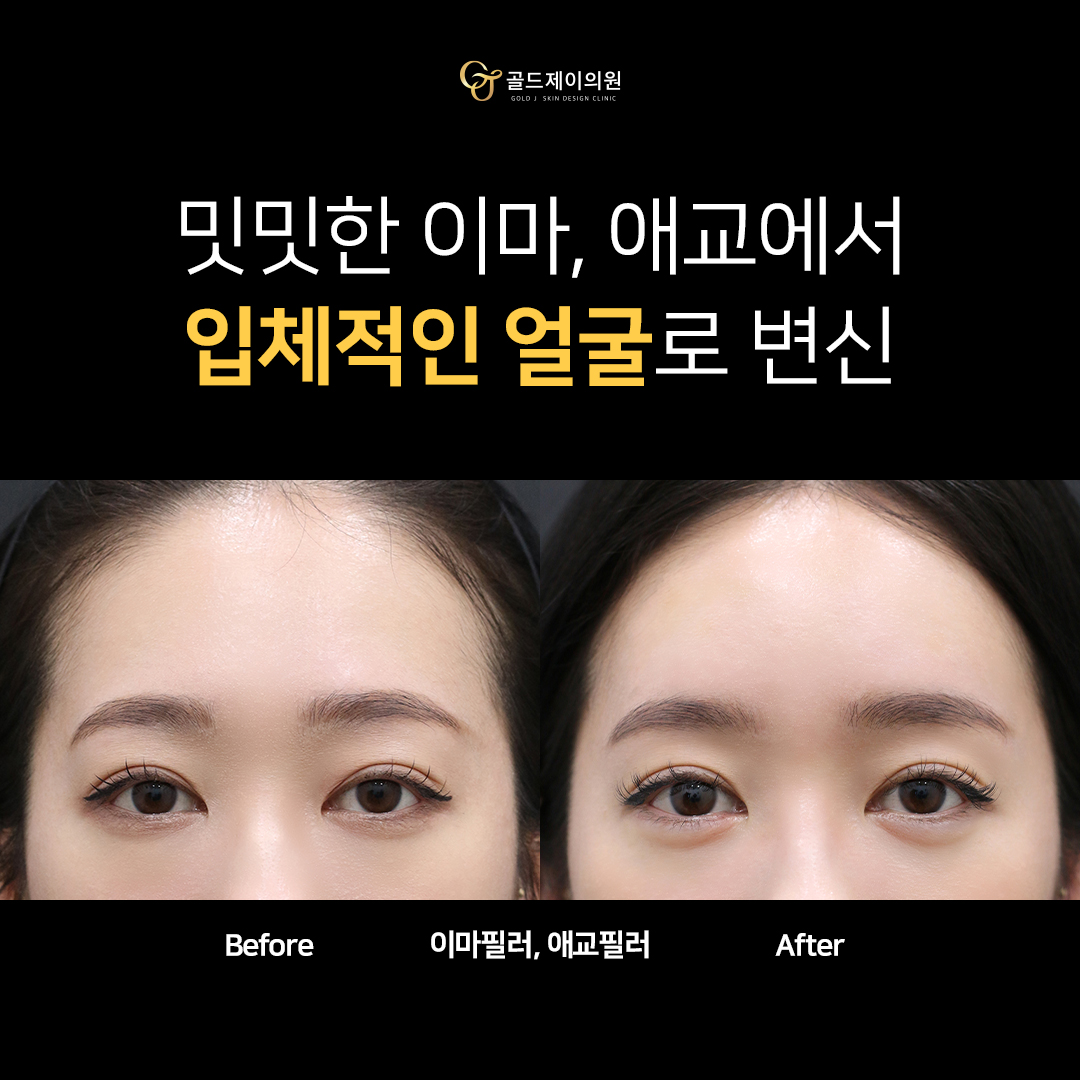 아치스퀘어 이마필러 전후 비교 — 정면