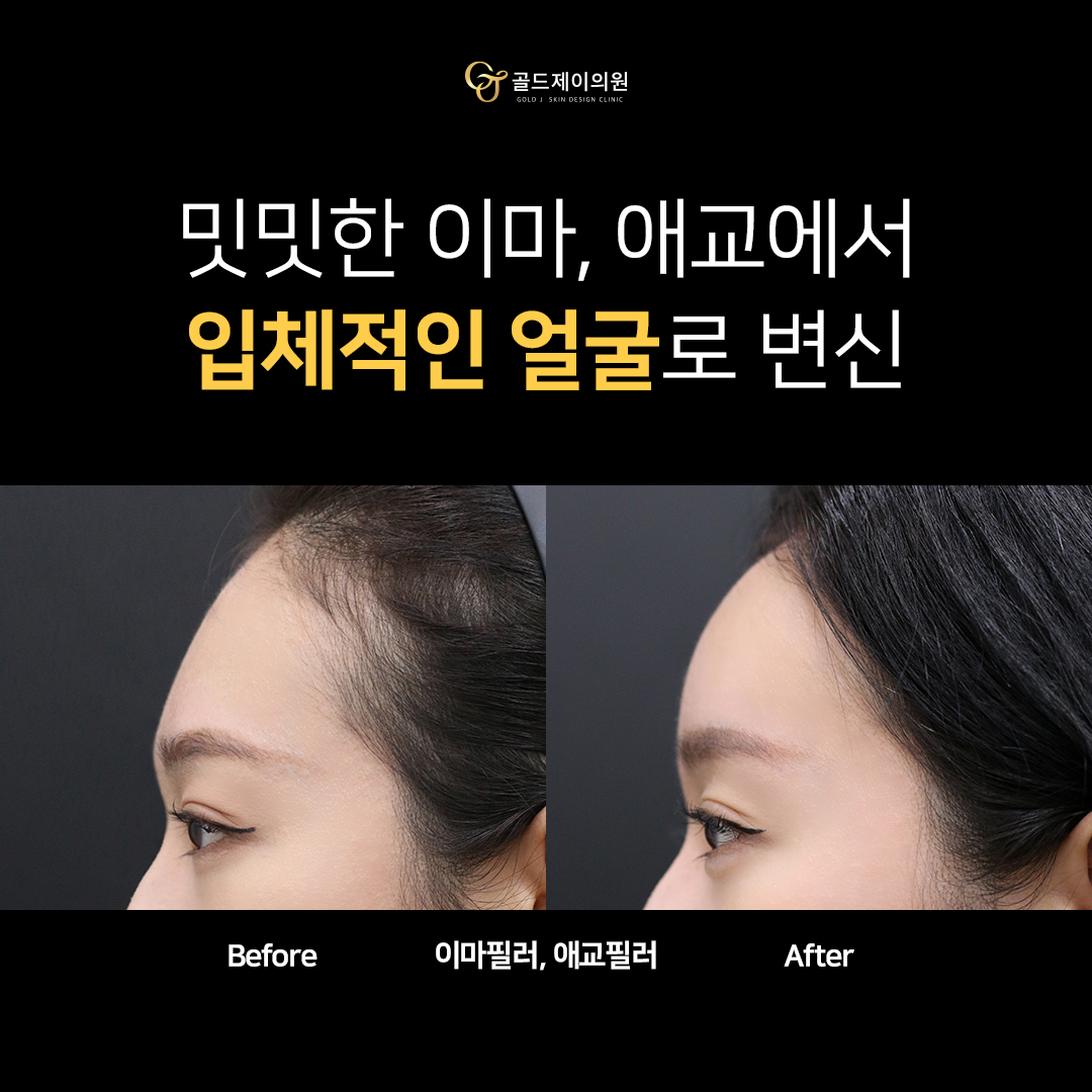 아치스퀘어 이마필러 전후 비교 — 측면