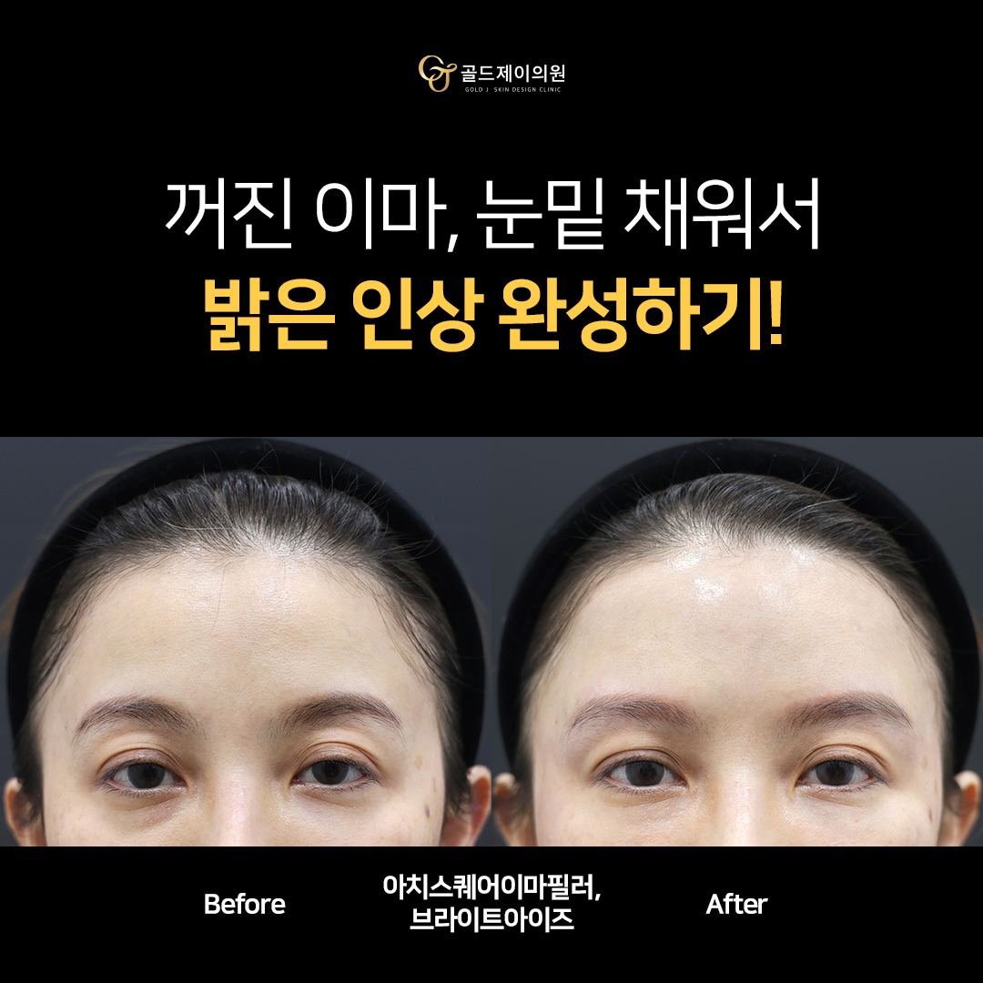 아치스퀘어 이마필러 전후 비교 — 정면