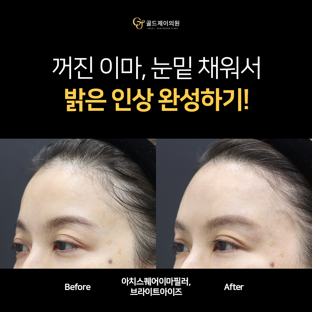 아치스퀘어 이마필러 전후 비교 — 측면