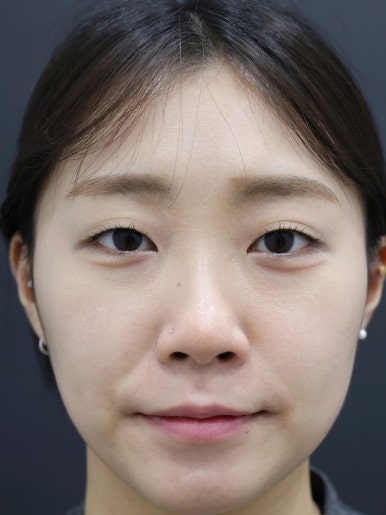 가로확장 입술필러 시술 전