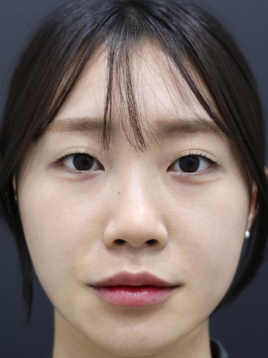 가로확장 입술필러 시술 후