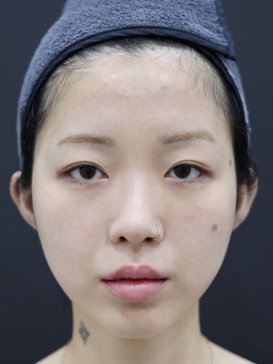 엘프귀 필러 시술 후