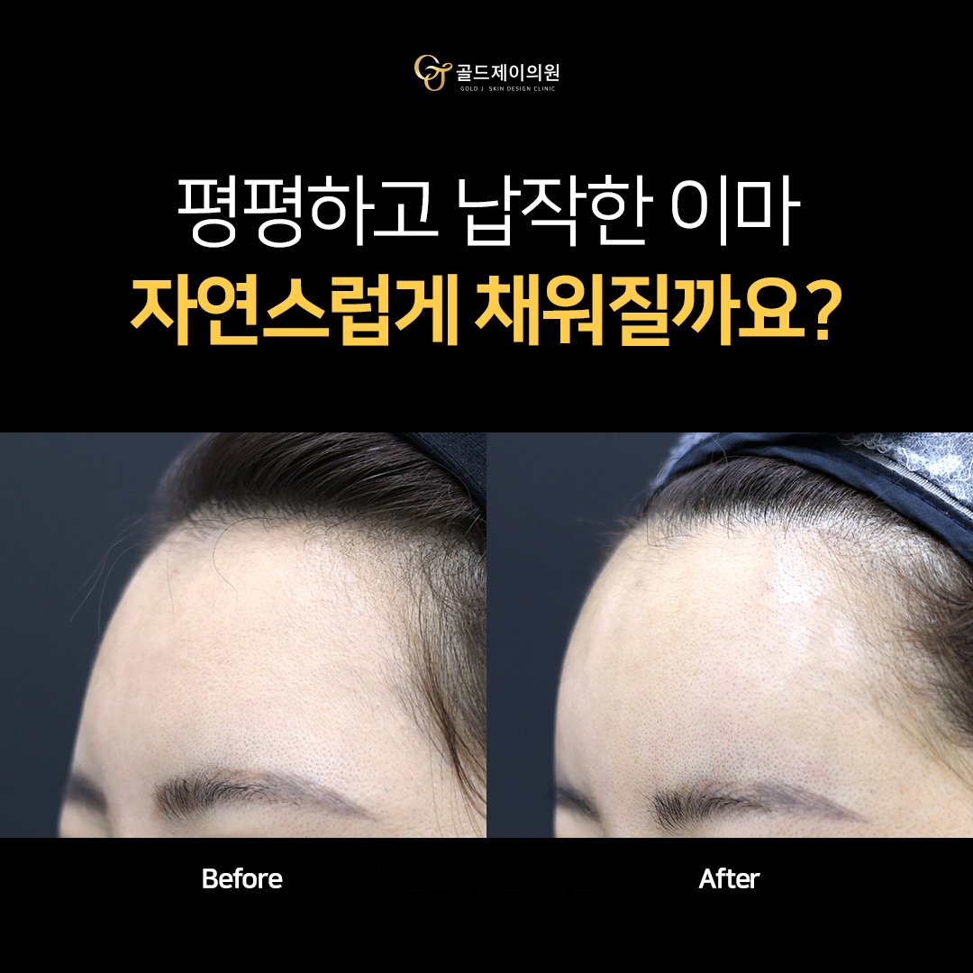 아치스퀘어 이마필러 전후