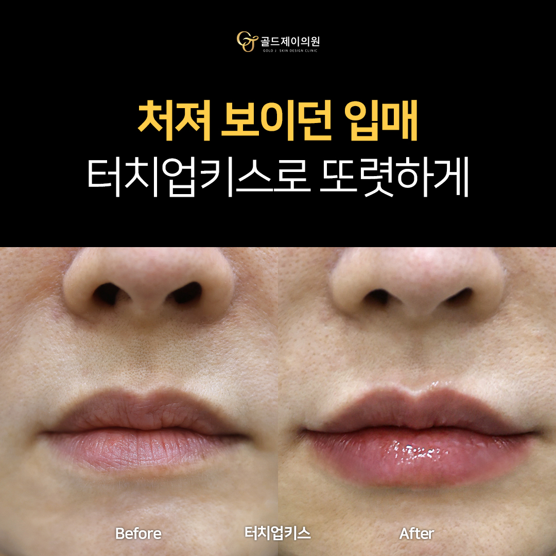 Lip filler before and after