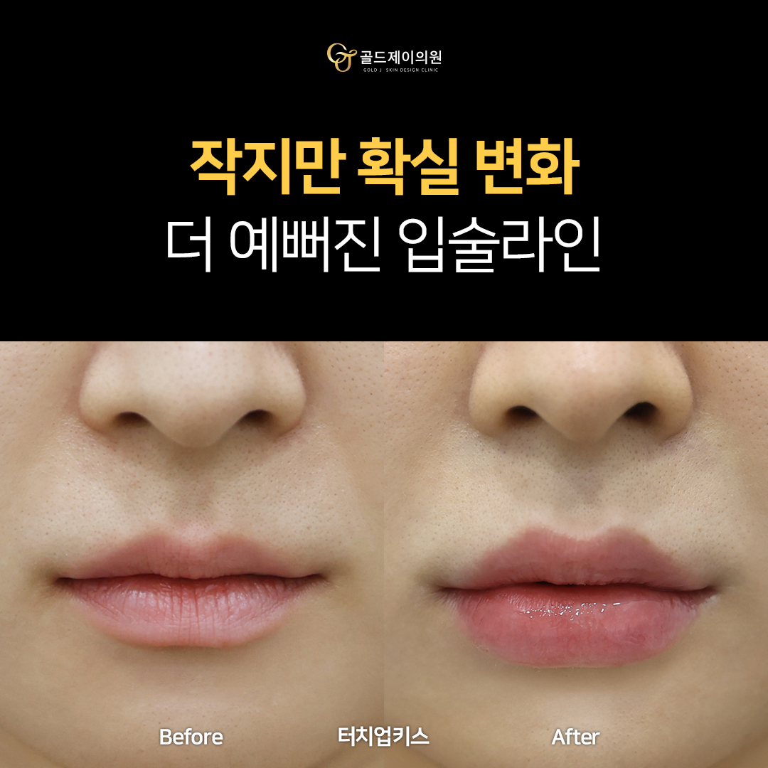 Lip filler before and after 2